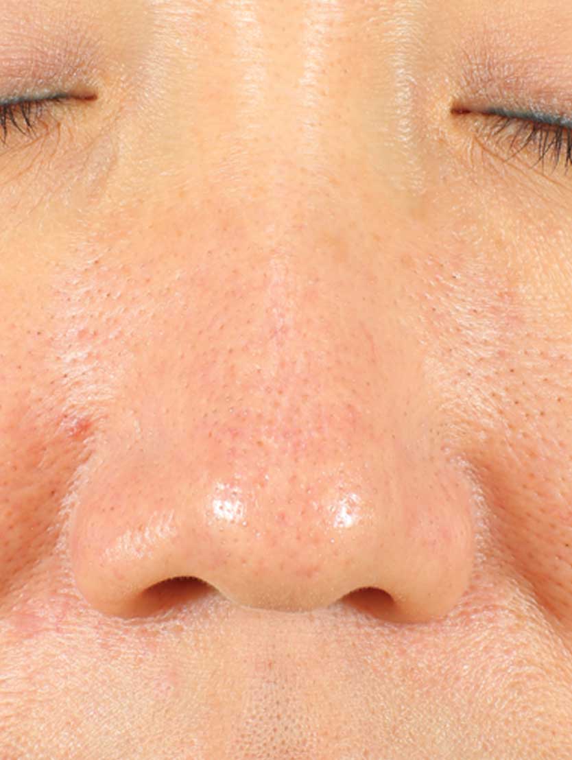 Close up of face focusing on nose before using product