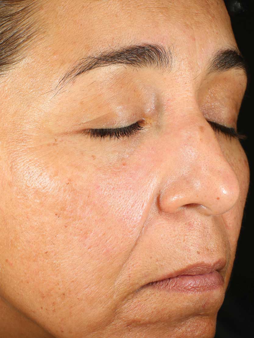Close up of face before using product